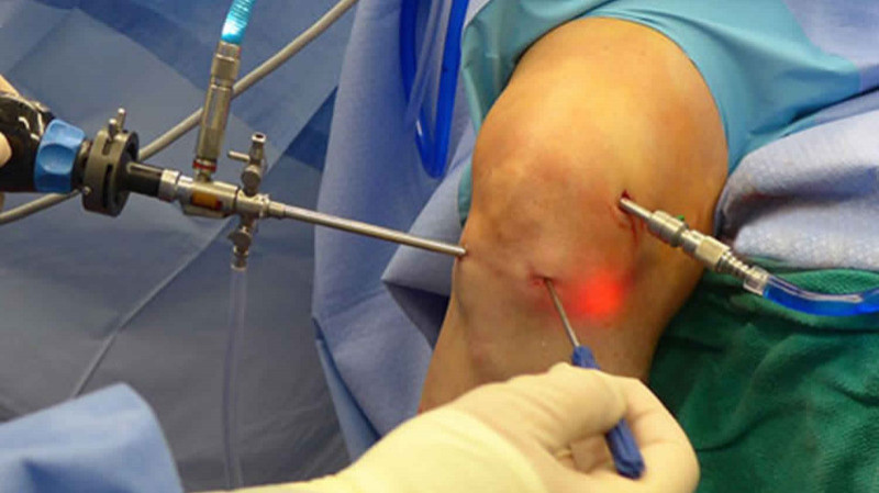 Arthroscopic Surgeries