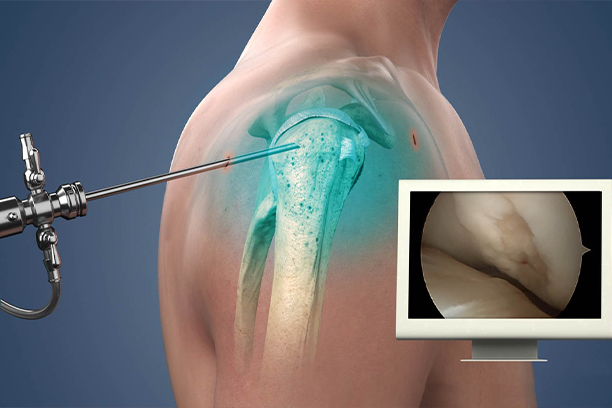 Shoulder Replacement Surgery